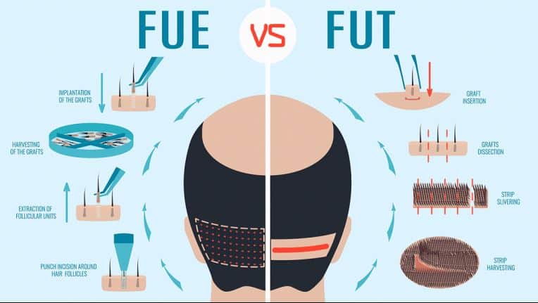 FUE ve FUT Saç Ekimi Arasındaki Farklar